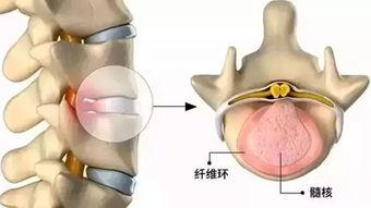 腰椎间盘突出视频,视频解析与防治要点