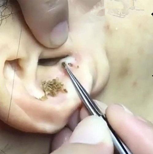 耳朵里黑头视频