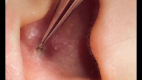 耳朵里黑头视频