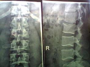 腰椎骨质增生怎么锻炼视频