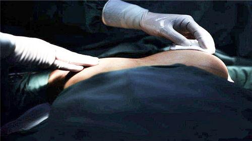 假体植入视频,从术前准备到术后恢复